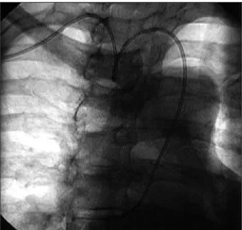 Fig. 3 – Increase in the radial artery output in GII (to the right) compared before and after examination, according to its diameter increase