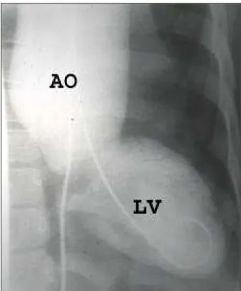 Fig. 3 – Patient 2’s ventriculography, demonstrating a bulky aneurysm that involves the ascending aorta.