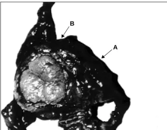 Fig. 2 – Histologic section of the adrenal cortex showing an area of normal appearance (A) and the nodule corresponding to the adenoma (B)