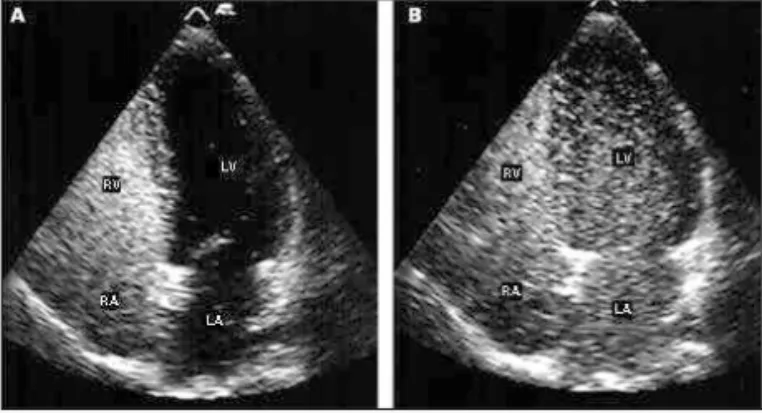 Fig. 1  - Transthoracic 2 -dimensional echocardiogram, apical 4 -chamber view: