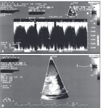 Fig. 1 - a) Outflow tract velocity showing a peak gradient of 57.2 mmHg at baseline; b) Severe mitral insufficiency demonstrated by color Doppler prior to infusion of normal saline.