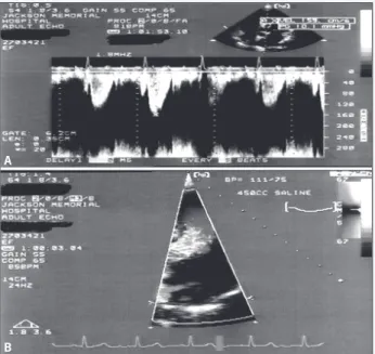 Fig. 2 - a) Outflow tract Doppler velocity demonstrating a significant reduction in the gradient to 10 mmHg after infusion of normal saline; b) Resolution of the mitral insufficiency after the saline infusion.