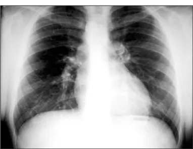Fig. 1  - Radiografia de tórax mostra a forma característica encontrada na tetralogia de Fallot, mas com acentuação da trama vascular pulmonar nas regiões hilares e arco médio retificado.