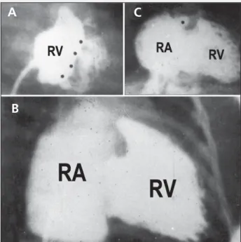 Fig. 1 – Right ventriculography in the anteroposterior projection in 3 group A patients