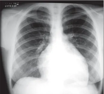 Fig. 1 - Radiografia de tórax salienta acentuado aumento da área cardíaca às cus- cus-tas das cavidades direicus-tas com trama vascular pulmonar diminuída.