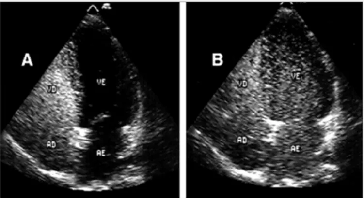 Fig. 1 - Bidimensional transthoracic echocardiogram, 4 chambers apical view: A) presence of contrast in right cambers; B) presence of contrast in left chambers after 6 cardiac cycles, compatible with intrapulmonary vascular dilations.