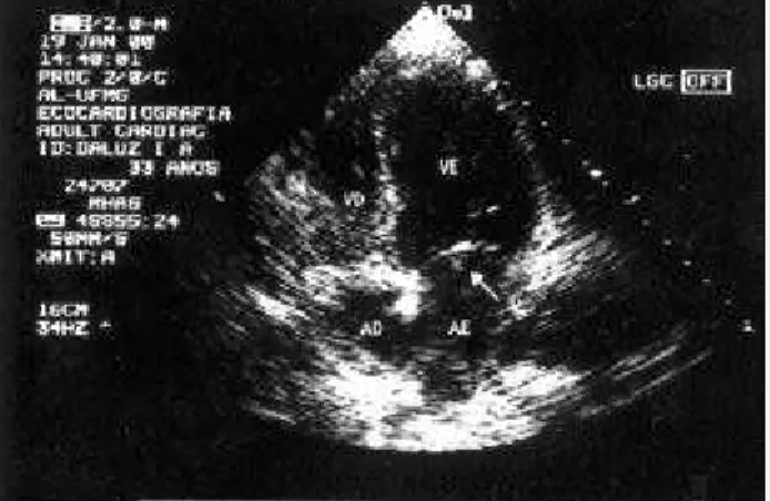 Fig. 1 - Initial transthoracic echocardiogram, showing a vegetation in the mitral valve.