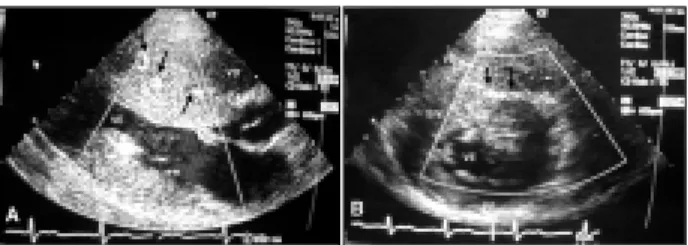 Fig. 2  A) gêmeo G, corte longitudinal. Presença de dilatações coronarianas septais detectadas com Doppler colorido (setas)