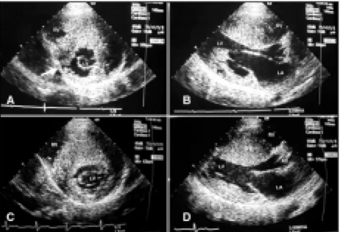Fig. 1 - A and B) two-dimensional echocardiogram of  twin V; C and D) two- two-dimensional echocardiogram of twin G