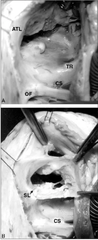 Fig. 1 - Surgical features of tricuspid valvuloplasty in Ebstein’s anomaly. A) Anato- Anato-mic features of the anomalous insertion of the posterior and septal leaflets of the  tri-cuspid valve; B) Tritri-cuspid valve partially detached from the ventricula