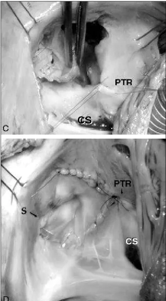 Fig. 2 - A) Preoperative echocardiogram showing the anomalous insertion of the tri- tri-cuspid valve leaflet