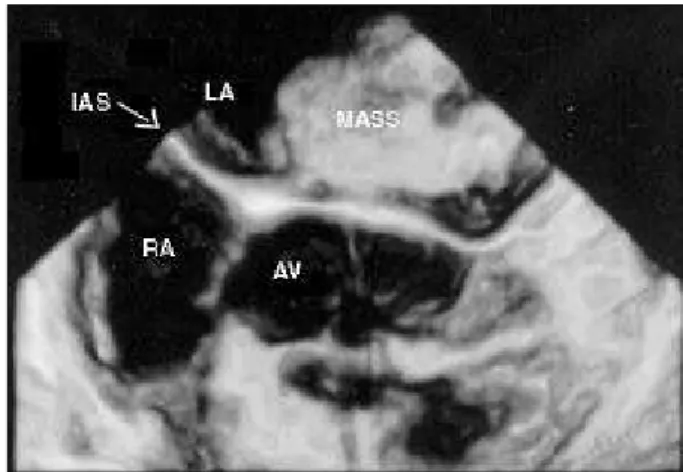 Fig. 4 - Gross appearance of the myxoma found inside the left atrium.