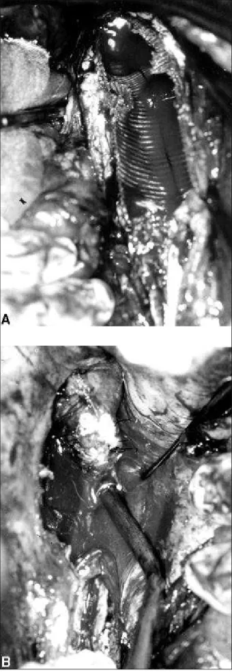 Fig. 3 - A) The graft is partially withdrawn. Detail of the reoperation to treat infection;