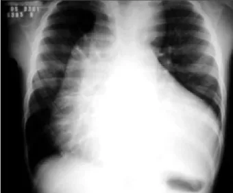 Fig. 1 - Radiografia de tórax salienta acentuado aumento da área cardíaca e do pedícu- pedícu-lo vascular decorrentes do ventrícupedícu-lo esquerdo e da aorta dilatados e com trama  vas-cular pulmonar congesta.