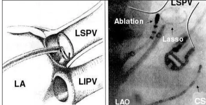Figure 1 - Pulmonary vein isolation technique to treat paroxysmal atrial fibrillation.