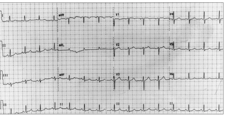 Fig. 3 - Electrocardiogram 3 months after presentation, showing complete reversal of the previous abnormalities.