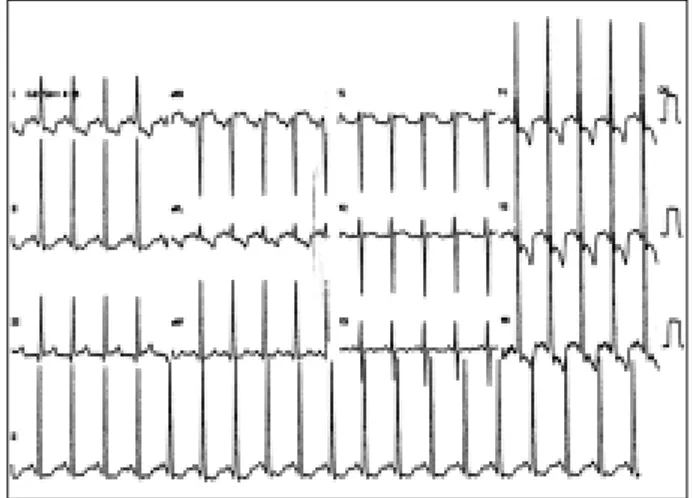 Fig. 1 - ECG at rest on hospital admission showing hypertrophy of the left chambers.