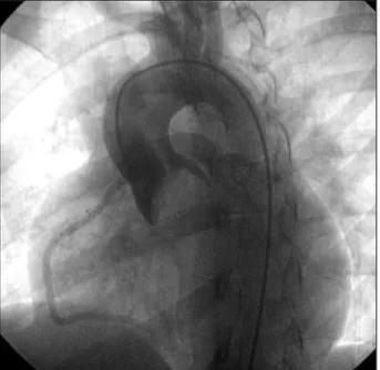 Fig. 2 - Aortogram in left anterior oblique projection. A bicuspid aortic valve with severe stenosis is seen (the decrease in opacity indicates flow through the stenotic valve).