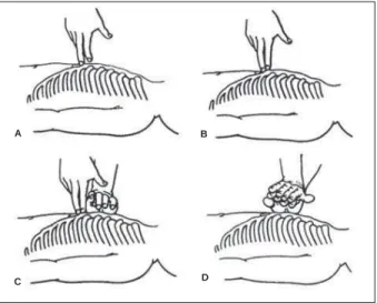 Fig. 3 - Manobra de Heimlich. A) Paciente consciente; B) Paciente inconsciente.