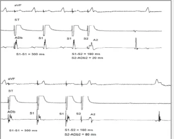Fig. 2 - Effects of atrial stimulation with pulsatile continuous electrical current on the time of conduction of the early atrial stimulus (S2) applied to the ST region and the time it takes to be conducted until the RAb region (upper part) and the LA regi