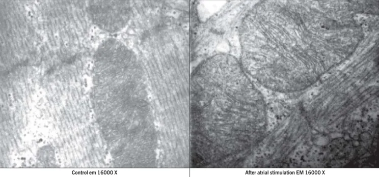 Fig. 5 - Electron microscopy (EM) of atrial tissue with a 16000-fold magnification, showing the effects of atrial stimulation with pulsatile continuous electrical current for 60 minutes on the myocytes