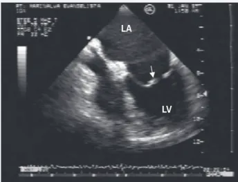 Table II shows the Doppler echocardiographic findings. The patients undergoing prosthetic implantation had a smaller mitral valve area, and, more often, restriction on mobility of the leaflets, calcification of the anterior leaflet, and fusion of the chord