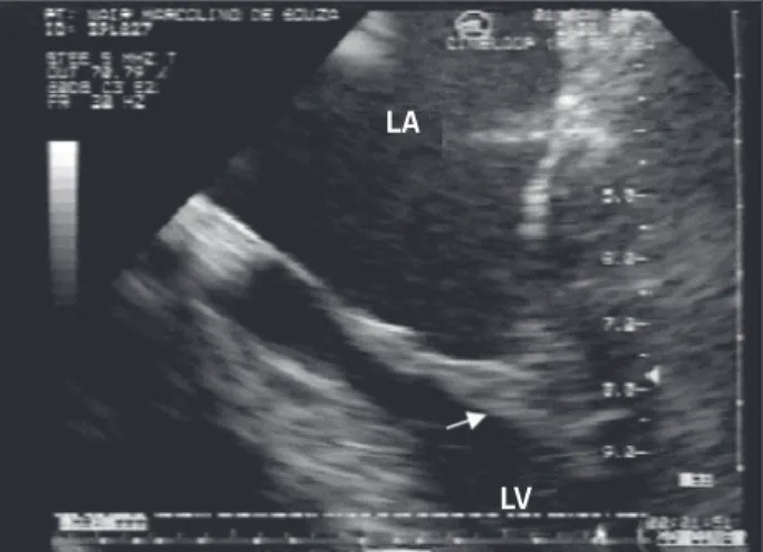 Table IV – Degree of mitral valve regurgitation 6 months after valvuloplasty