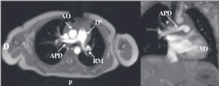 Fig. 3 - Angioresonance: postoperative view of the surgical correction showing normal blood flow through the pulmonary trunk (TP) and both right and left pulmonary arteries (RPD, RPI).
