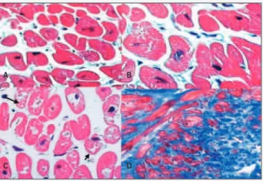 Fig. 3 - Microphotograph of endomyocardial biopsy from specimens obtained during surgery, showing important histopathological alterations