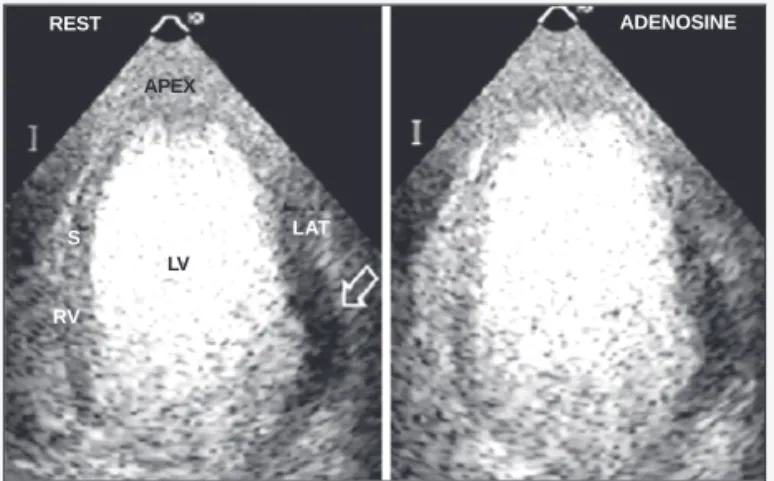 Fig. 4 - Example of concordance between the methods in a 54-year-old male patient with chest pain suggestive of angina
