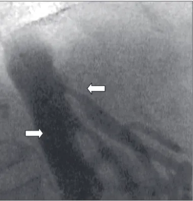 Fig. 2 - Projeção ântero-posterior demonstrando estenose grave no óstio e segmento proximal do tronco celíaco (seta).