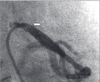 Fig. 5 - Projeção lateral esquerda demonstrando recuperação luminal com míni- míni-ma estenose residual após o implante do stent (seta).