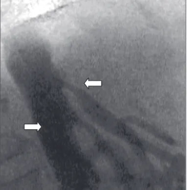 Fig. 2 - Anteroposterior projection demonstrating severe stenosis in the ostium and segment proximal to the celiac trunk (arrow).