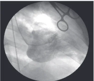 Fig. 1 - Anterior descending arteriogram showing diffuse lesion in the middle and distal segments.