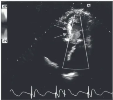 Fig. 1 - Two-dimensional transthoracic echocardiography with color-flow mapping showing a relatively hyperechoic interventricular septum, which is morphologically altered with thinning in its basal, middle, and apical portions (arrows).