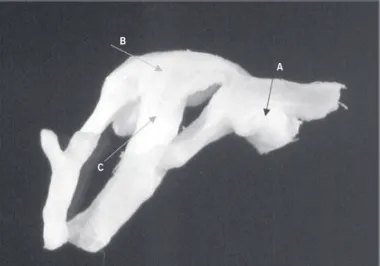 Fig. 5 - Microscopic analysis (HE) of the mitral valvular leaflet (20X magnification) with areas of neovascularization (arrows), mucoid degeneration, and fibrosis.