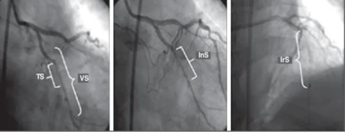 Fig. 1 - TS (target segment): distal and proximal margins of the target lesion;