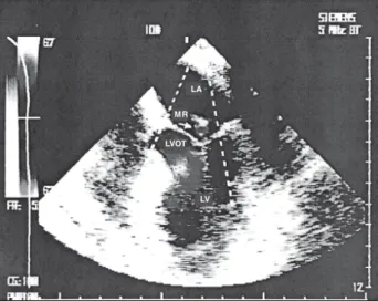 Fig. 4 - A) Transesophageal echocardiography: frontal view showing blood flow in the left ventricular outflow tract; peak gradient (186 mmHg) obtained with continuous Doppler when the frequency of the intra-aortic balloon of  counter-pulsation was 1:1 and 