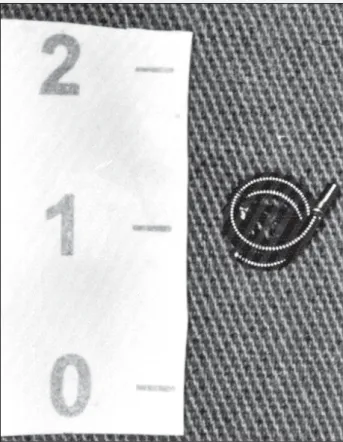 Fig. 1 - Image obtained on interventional catheterization, during which a coil detached from the site of the ductus arteriosus and become embedded in the left