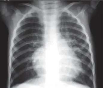 Fig. 1 - Radiografia de tórax mostra a forma característica da encontrada na tetralogia de Fallot mas com acentuação da trama vascular pulmonar nas regiões hilares.