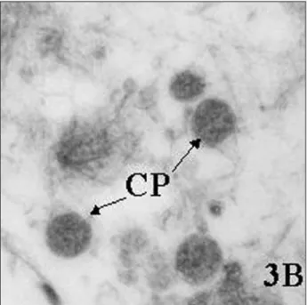 Fig. 3A - Concentration of Chlamydia pneumoniae elementary bodies (CP) and Mycoplasma pneumoniae (MP) round structures involved in only one membrane into a focus of calcification