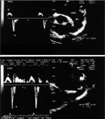 Fig. 1 – Curves of flow velocity of the left atrial appendage obtained through the study with pulsatile Doppler, at the cross section of two chambers, with the volume sample positioned inside the cavity