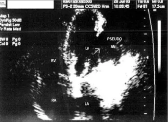 Fig. 2 - Cardiac magnetic nuclear resonance evincing the relation among the right ventricular cavity (RV), left ventricular cavity (LV), and ventricular aneurysm (Aneu)