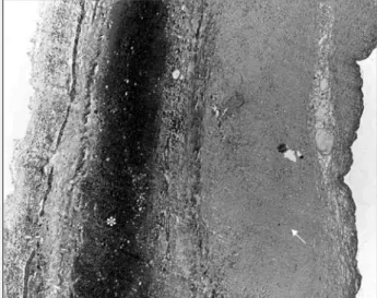 Fig. 4 - Anatomopathologic findings. Cavitary lesion wall constituted by a thick layer of fibrosis (arrow), re-covering a hematoma characterized by erythrocytes (especially present in the asterisk area, but also out of it, including among collagen)