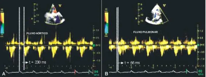 Fig. 2  - Medida do atraso interventricular pelo modo M (VD - ventrículo direito;
