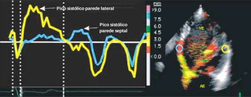 Fig. 3  - Quantificação do atraso eletromecânico intraventricular pelo Doppler tecidual