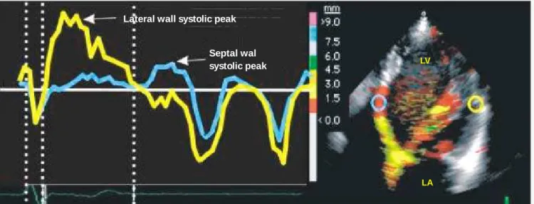 Fig. 4  - Measure of the electromechanical delay in the basal regions of the septal (green curve - 5 0 0  ms) and lateral (yellow curve - 2 3 5  ms) walls
