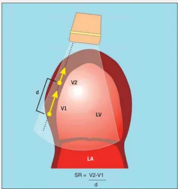 Fig. 1 - Strain rate (SR) measures the intramyocardial gradient of velocity between 2 close points of a muscular segment (V1 and V2) in relation to distance (d) between those points.