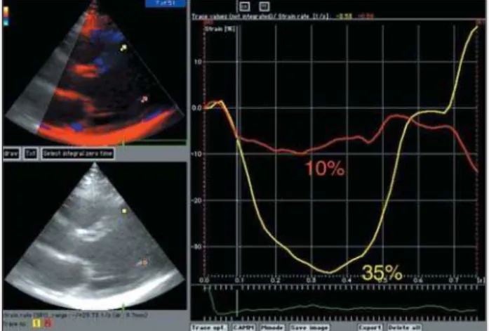 Fig. 4 - Patient from the group with the undetermined form of Chagas’ disease showing normal strain in the septal wall (yellow curve) and abnormal strain in the posterior wall (red curve)