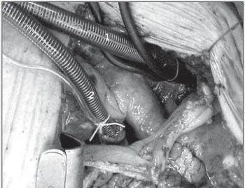 Fig. 2 – Surgical technique for repairing thoracic and thoracoabdominal aneurysm.